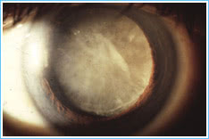 mature-cataract