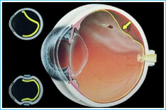 1. Retinal Detachment Department-graphic 1. Retinal Detachment Department-graphic
