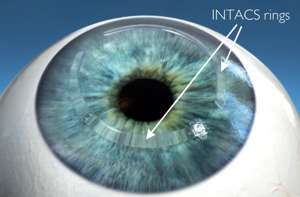 2. Cornea Intacs