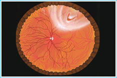 2. Peripheferal-retinal-hole 2. Peripheferal-retinal-hole