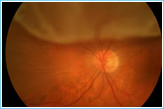3. Retinal Detachment 3. Retinal Detachment