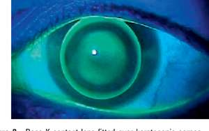 4. Rose-K Lens
