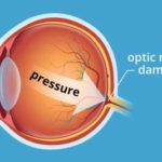Congenital-Glaucoma 2 Congenital-Glaucoma 2