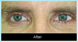 After-prosthesis After-prosthesis