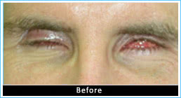 Before-prosthesis Before-prosthesis