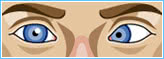 Convergent-squint Convergent-squint