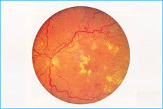 Diabetic-maculopathy Diabetic-maculopathy