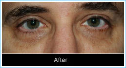 Ptosis-correction-after Ptosis-correction-after