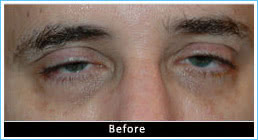Ptosis-correction-before Ptosis-correction-before