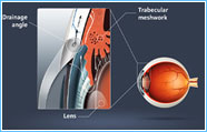 Acquired Glaucoma - Sunayana Eye Hospital Acquired Glaucoma - Sunayana Eye Hospital