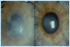 Before & After Cornea Grafting - Refractive Surgery Sunayana Eye Hospital