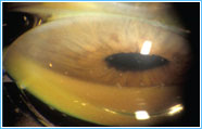 Congenital Glaucoma - Sunayana Eye Hospital Congenital Glaucoma - Sunayana Eye Hospital