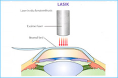 LASIK Procedure Animation - Sunayana Eye Hospital