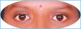 After-squint-surgery After-squint-surgery