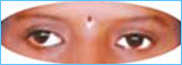 Before-squint-surgery Before-squint-surgery